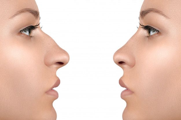 Burun Estetiği - Rhinoplasty